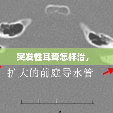 突发性耳聋怎样治， 